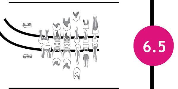 One growth stage from the Dental Development Atlas formulated by Esan and Schepartz for South African black children shows dental development at age 6.5 years.©Esan and Schepartz March 2017